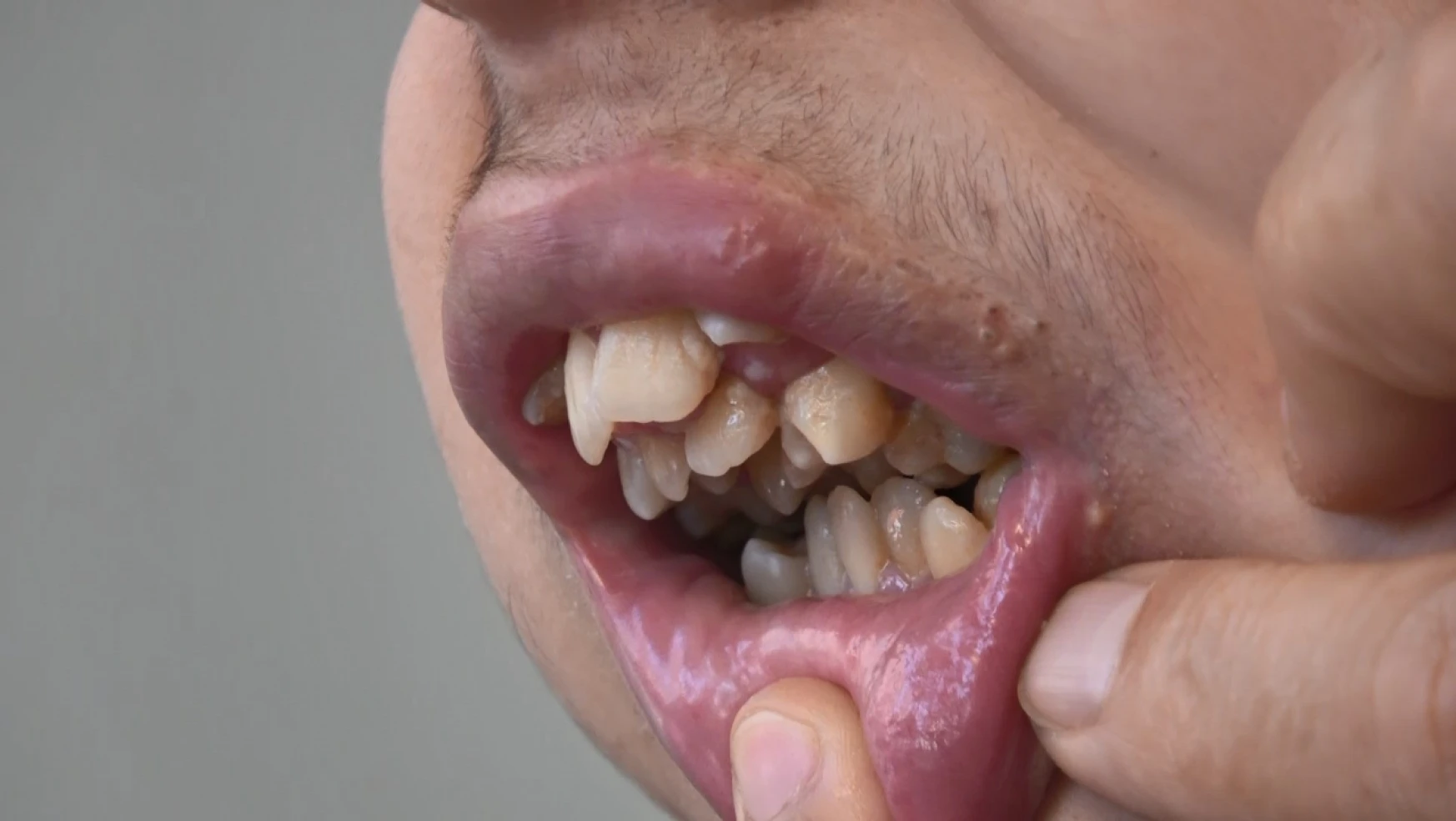 Alt Çenesi Yok, Dişleri Üst Damağında, Ameliyat İçin Yardım Bekliyor