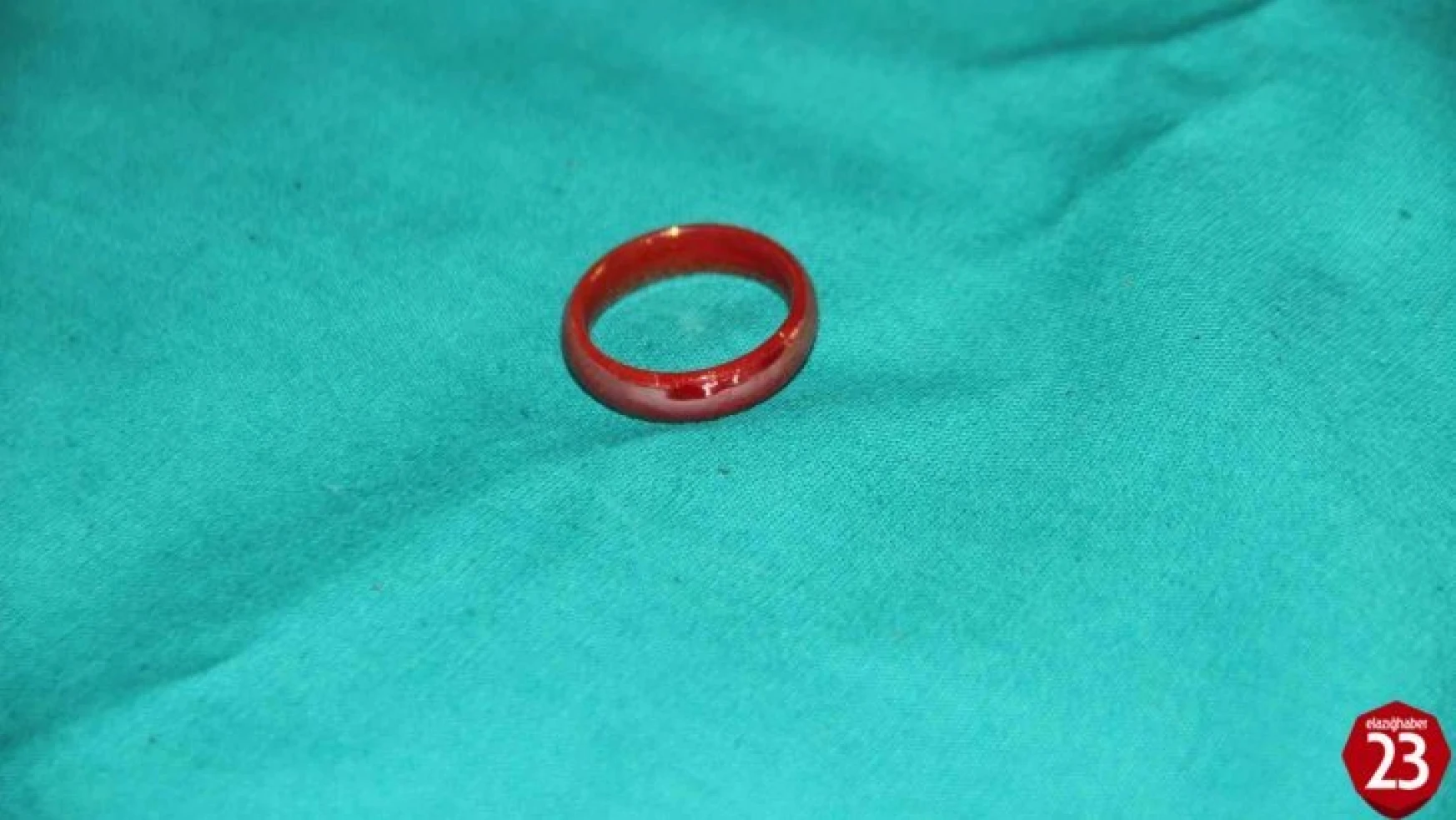 Oyun Oynarken Yerdeki Yüzüğü Yutan 3 Yaşındaki Çocuk Ölümden Döndü