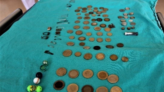 Çocukların midesinden çıkan onlarca yabancı cisim şaşırttı