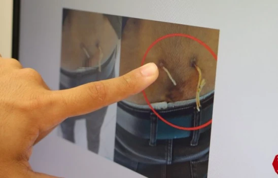 Elazığ'da Ağrıları Geçsin Diye Beline Çamaşır İpi Geçirmişler