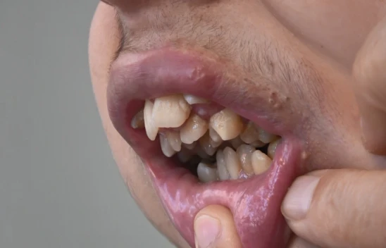 Alt Çenesi Yok, Dişleri Üst Damağında, Ameliyat İçin Yardım Bekliyor