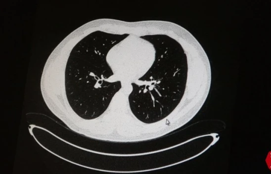 Korona Artık Gençleri Vuruyor, İşte Kanıtı !