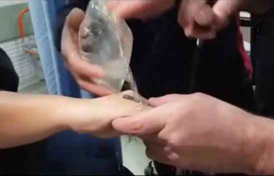 Elazığ'da parmağa sıkışan yüzüğü itfaiye ekipleri çıkardı