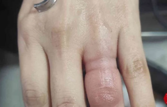 Parmağa sıkışan yüzüğü itfaiye ekipleri çıkardı