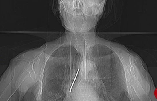 Elazığ'da 91 Yaşında ki Keko Dedenin Soluk Borusuna Kaçan 10 Santimlik Çivi Çıkarıldı